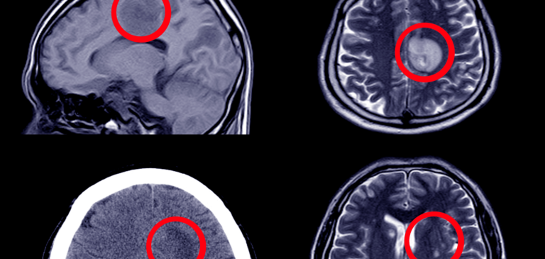 Misdiagnosis of Strokes, Mini-Strokes, and Aneurysms